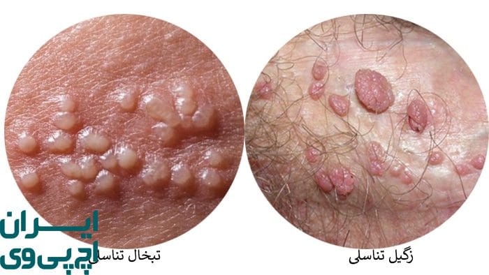 بهترین درمان تبخال تناسلی