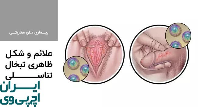 بهترین درمان تبخال تناسلی