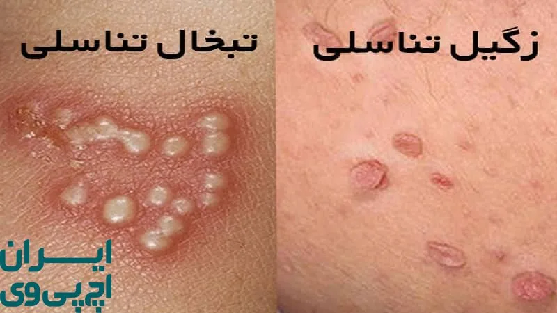 آیا تبخال تناسلی همان HPV است؟