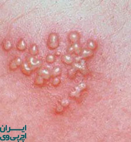 آیا تبخال تناسلی درمان قطعی دارد؟