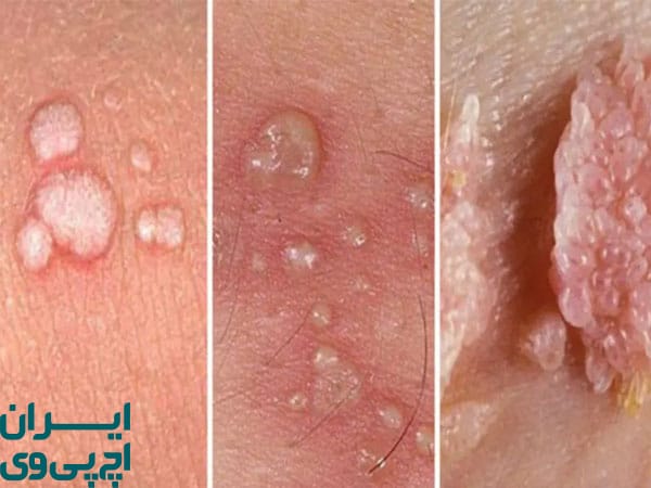 آیا درمان سریع HPV برای همه مناسب است؟