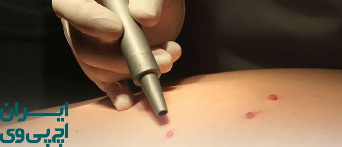 آیا زگیل تناسلی با درمان پزشکی به‌طور کامل حذف می‌شود؟