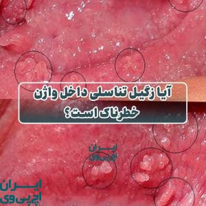 آیا زگیل تناسلی داخل واژن خطرناک است؟