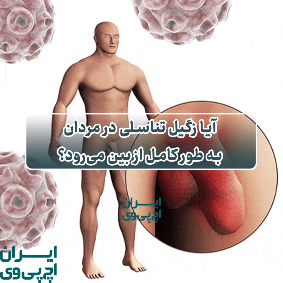 آیا زگیل تناسلی در مردان به طور کامل از بین می‌رود؟