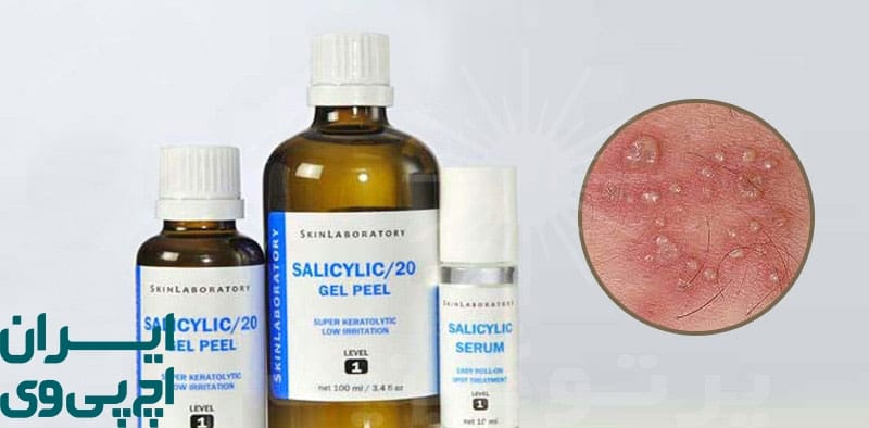 آیا پودوفیلین می‌تواند زگیل را برای همیشه ریشه‌ کن کند؟