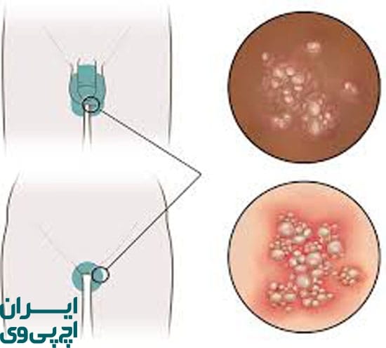 ازگیل تناسلی دقیقاً چیست و چطور منتقل می‌شود؟