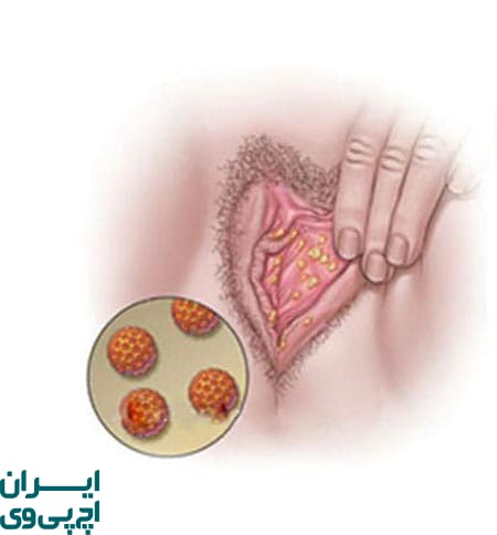 افزایش تعداد و اندازه زگیل‌ها