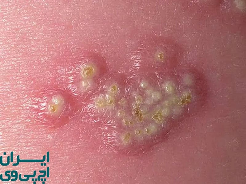 اولین علائم تبخال تناسلی در زنان