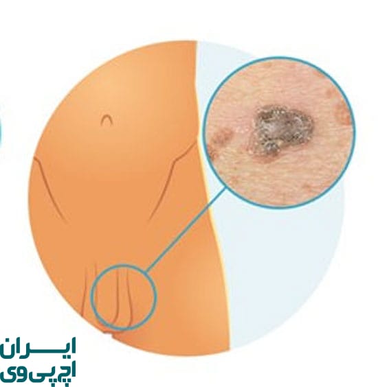 اگر زگیل تناسلی برگردد، چه کنیم؟