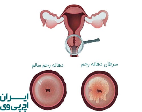 بروز سرطان دهانه رحم