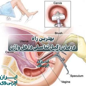 بهترین راه درمان زگیل تناسلی داخل واژن
