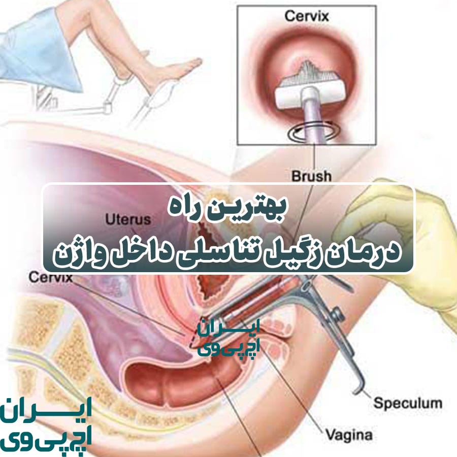 بهترین راه درمان زگیل تناسلی داخل واژن