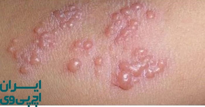 بهترین روش‌های درمانی برای کنترل تبخال تناسلی