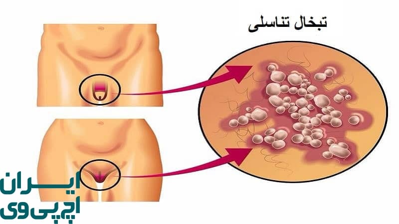 تبخال تناسلی چیست و چگونه منتقل می‌شود؟
