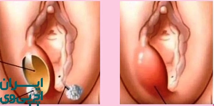 تبخال تناسلی چیست؟