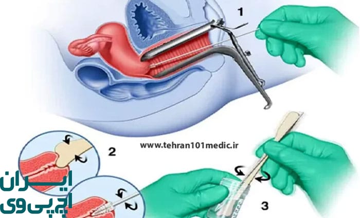 تشخیص زگیل HPV داخلی