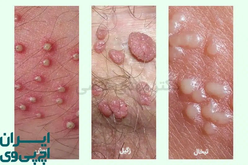 تشخیص زگیل تناسلی با تبخال تناسلی