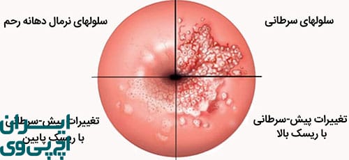تغییر سلول‌های دهانه رحم (CIN)