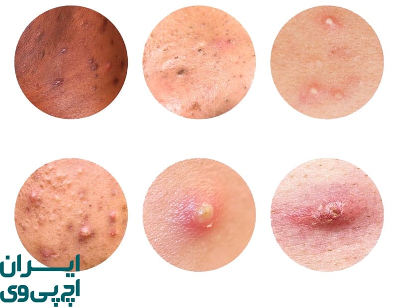 تفاوت زگیل تناسلی و جوش معمولی