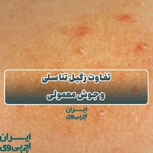 تفاوت زگیل تناسلی و جوش معمولی