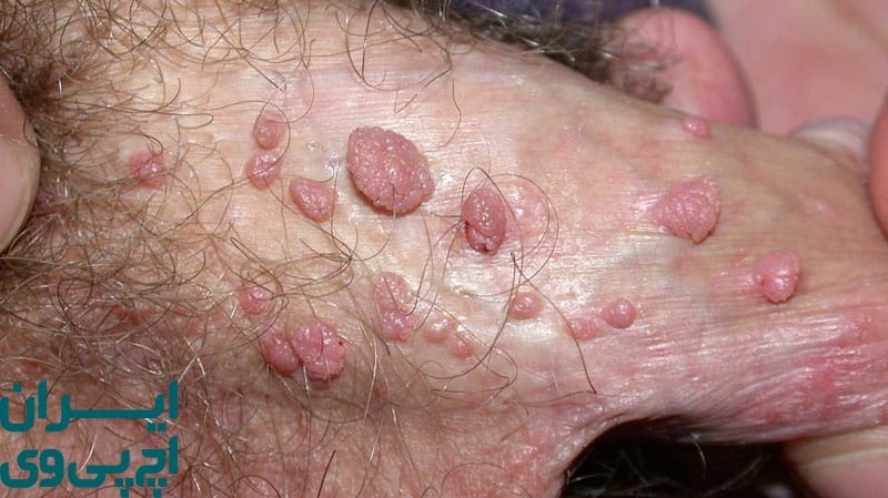 تفاوت ظاهری زگیل تناسلی یا جوش