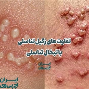 تفاوت‌های زگیل تناسلی با تبخال تناسلی