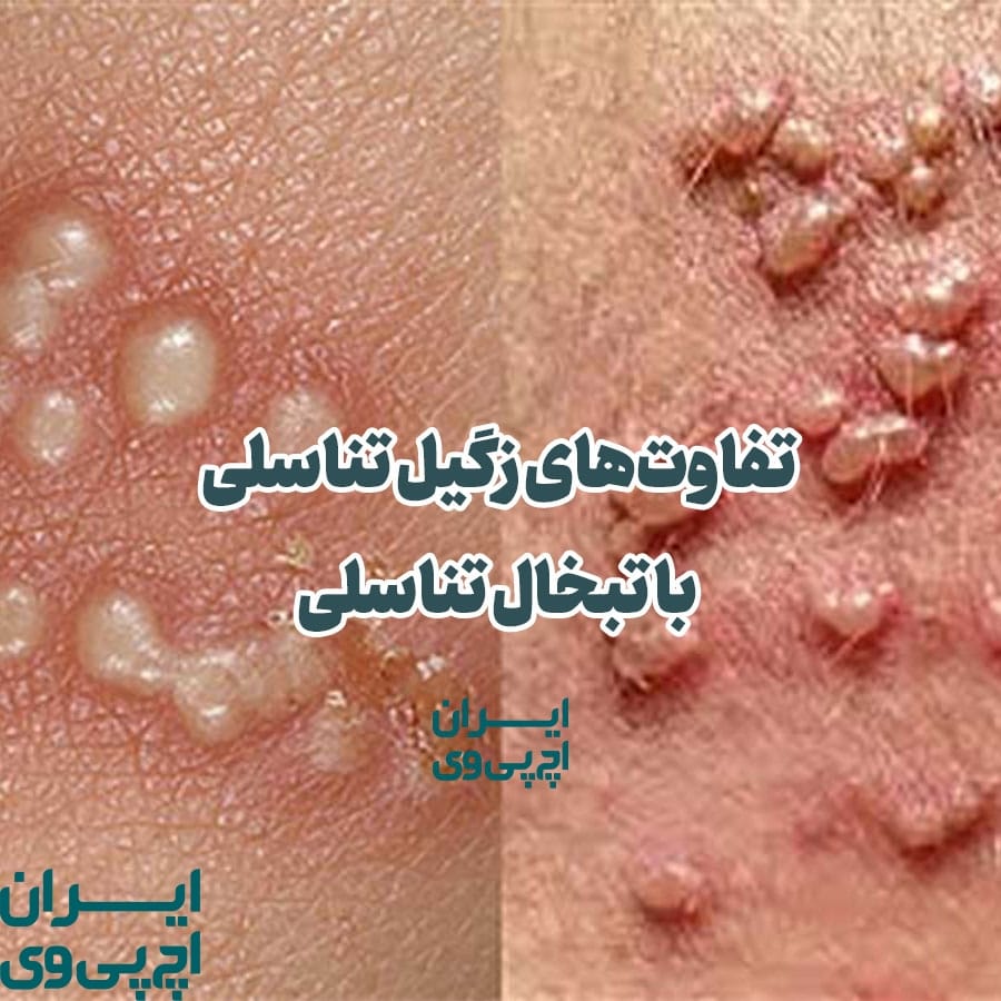 تفاوت‌های زگیل تناسلی با تبخال تناسلی