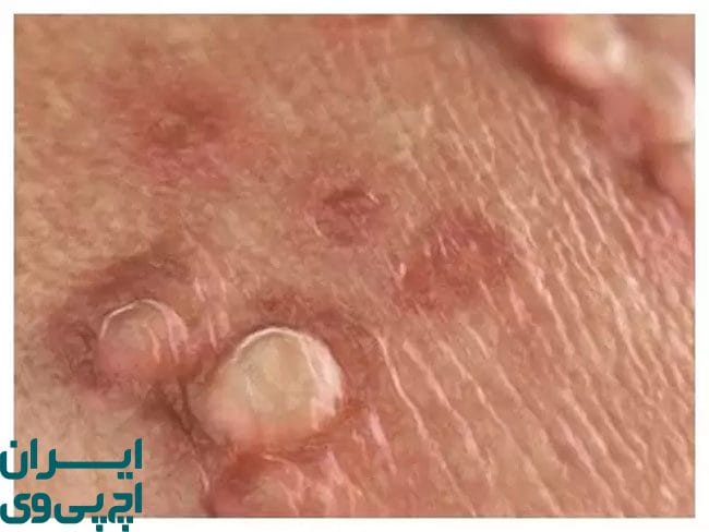 تفاوت‌های زگیل تناسلی با تبخال تناسلی در درمان و پیشگیری