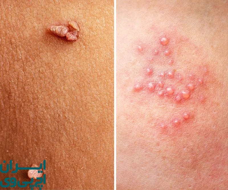 تفاوت‌های زگیل تناسلی با تبخال تناسلی و نحوه انتقال 