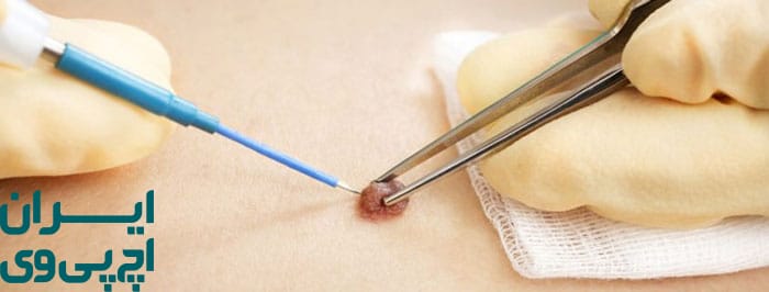 جراحی (برداشتن فیزیکی زگیل)