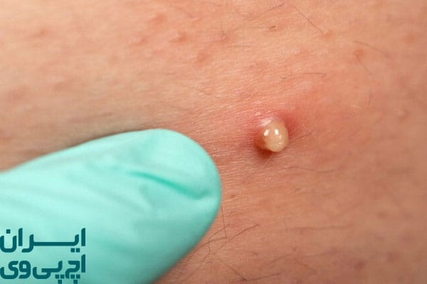 جوش تناسلی چیست؟