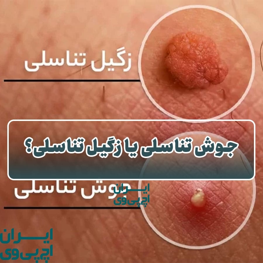 جوش تناسلی یا زگیل تناسلی؟