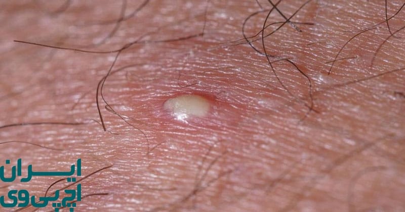 جوش معمولی چیست