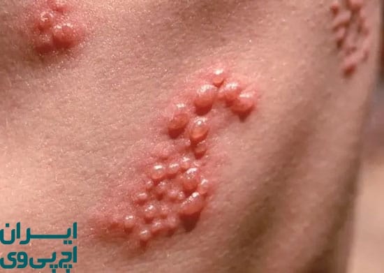 خطرات بلند مدت و مزمن تبخال تناسلی در زنان