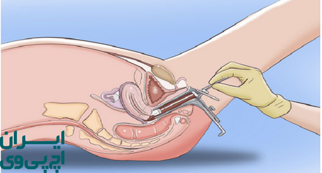 خطرات زگیل تناسلی داخلی برای سلامت زنان