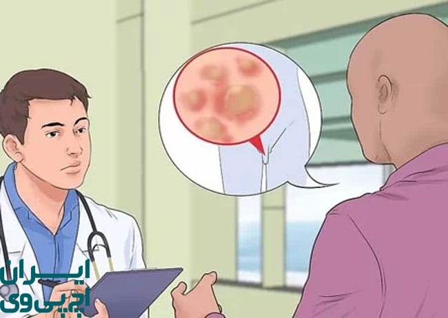 دارو های خوراکی ضد ویروسی تبخال تناسلی