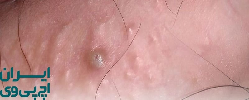 درمان جوش تناسلی در مردان