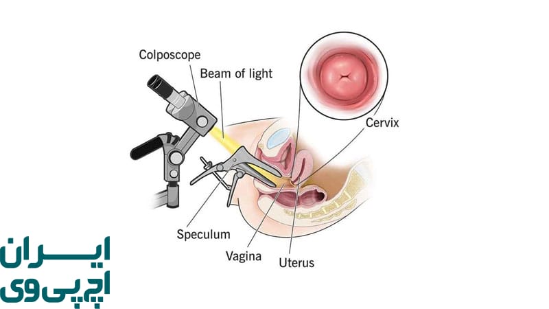 درمان زگیل تناسلی داخل واژن