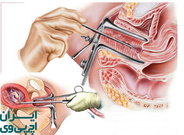 درمان زگیل واژن