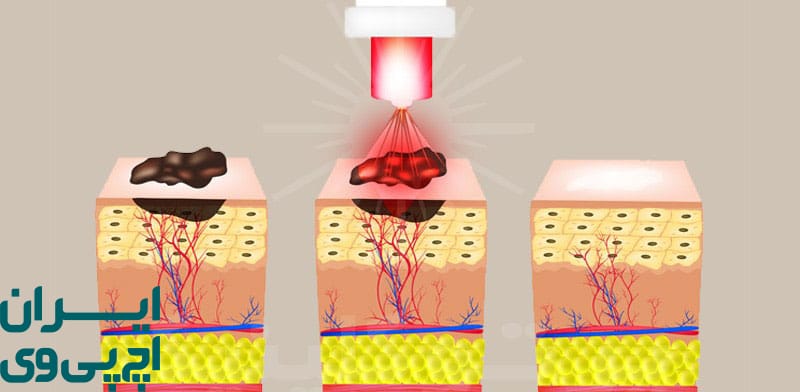روش‌ های مختلف درمان زگیل تناسلی در مردان