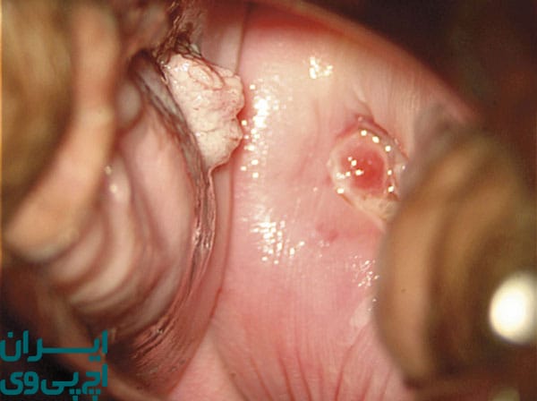 روش‌های درمان زگیل تناسلی داخل واژن