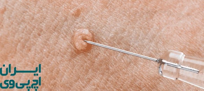 روش‌های نوین درمان زگیل تناسلی در مردان