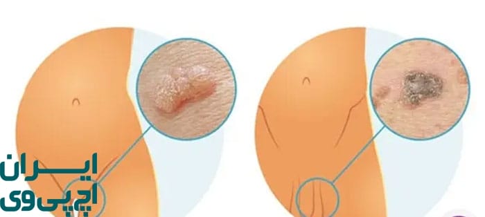  زمان‌بندی استاندارد درمان زگیل تناسلی با پودوفیلین