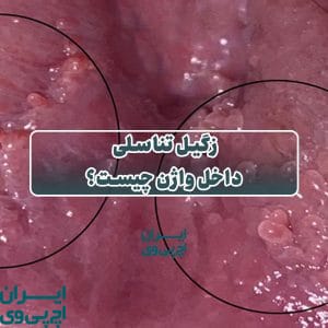 زگیل تناسلی داخل واژن چیست