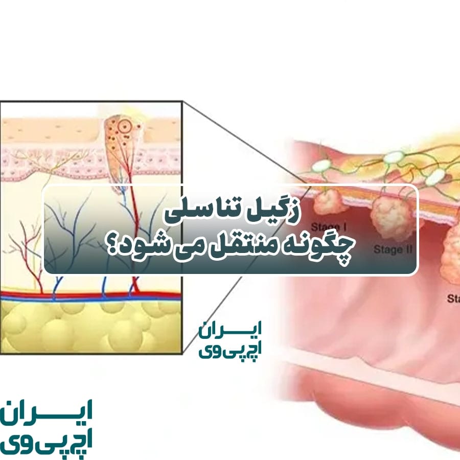 زگیل تناسلی چگونه منتقل می‌شود؟