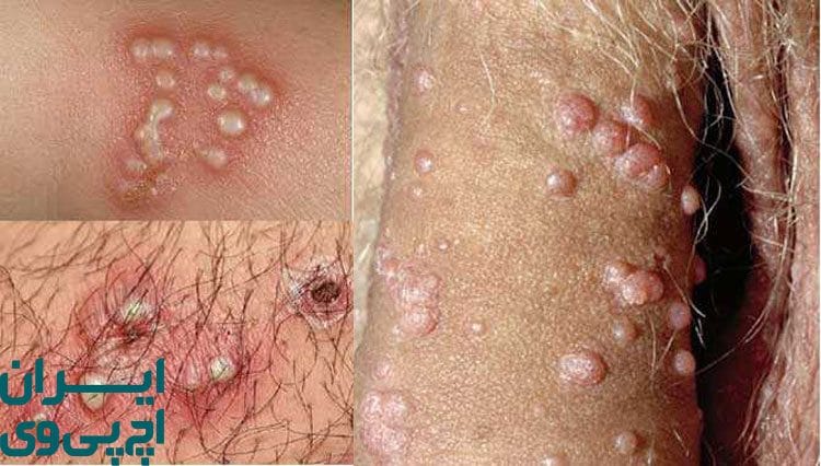 زگیل تناسلی چیست و چرا اهمیت دارد؟