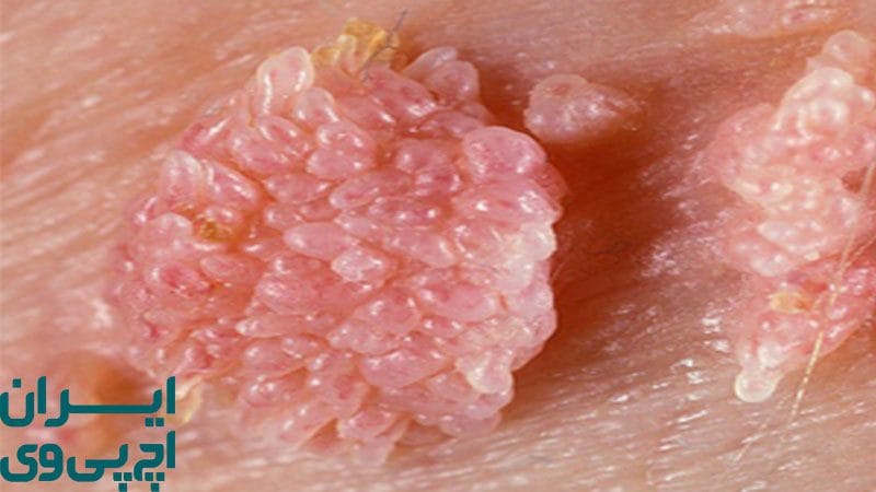 زگیل تناسلی چیست؟