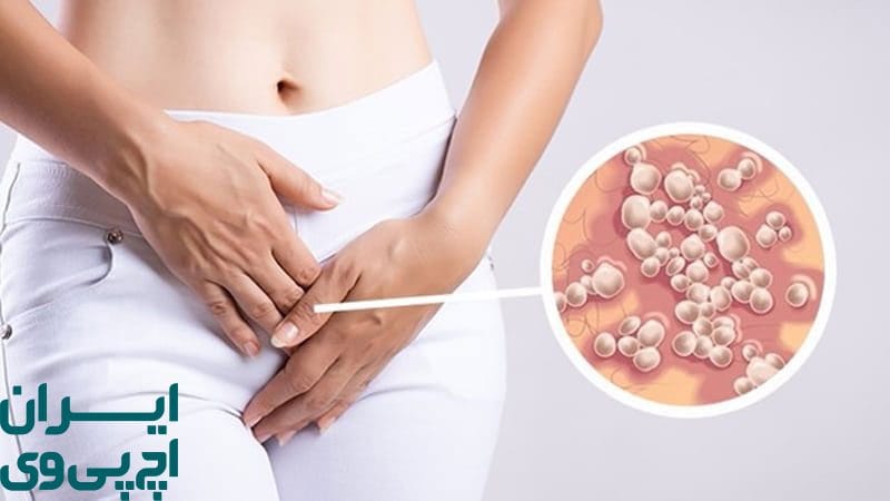 عامل ایجاد بیماری و تفاوت‌های زگیل تناسلی با تبخال تناسلی