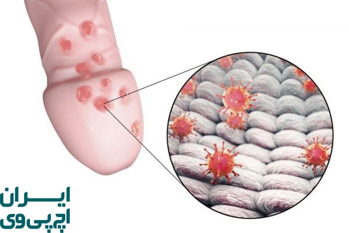 علائم تبخال تناسلی در مردان