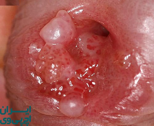 علت ایجاد زگیل‌های داخلی واژن